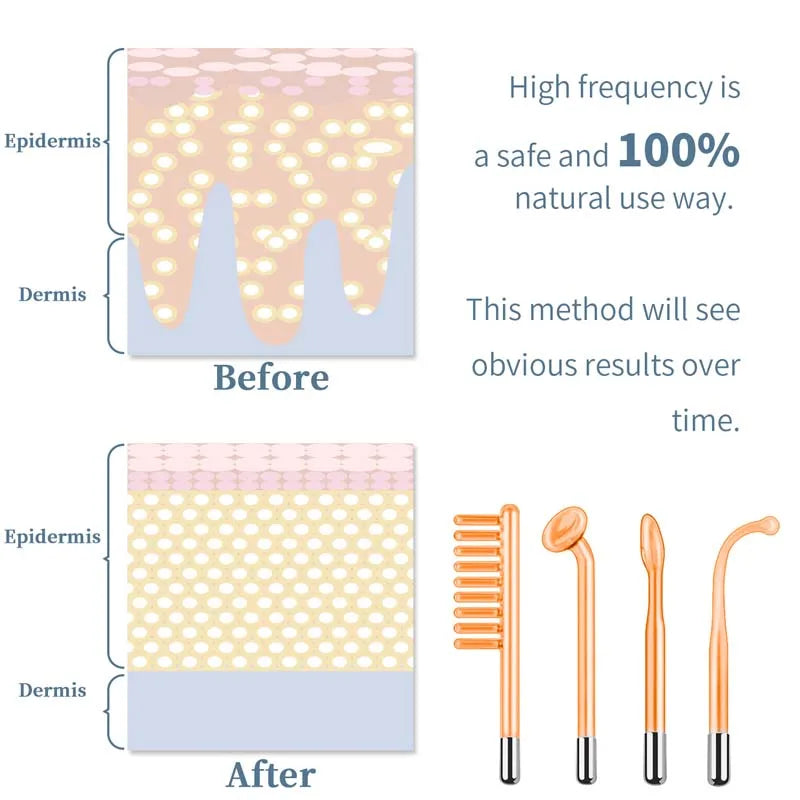 High Frequency Facial Wand – Portable Skin Care Machine with 4 Tube Attachments