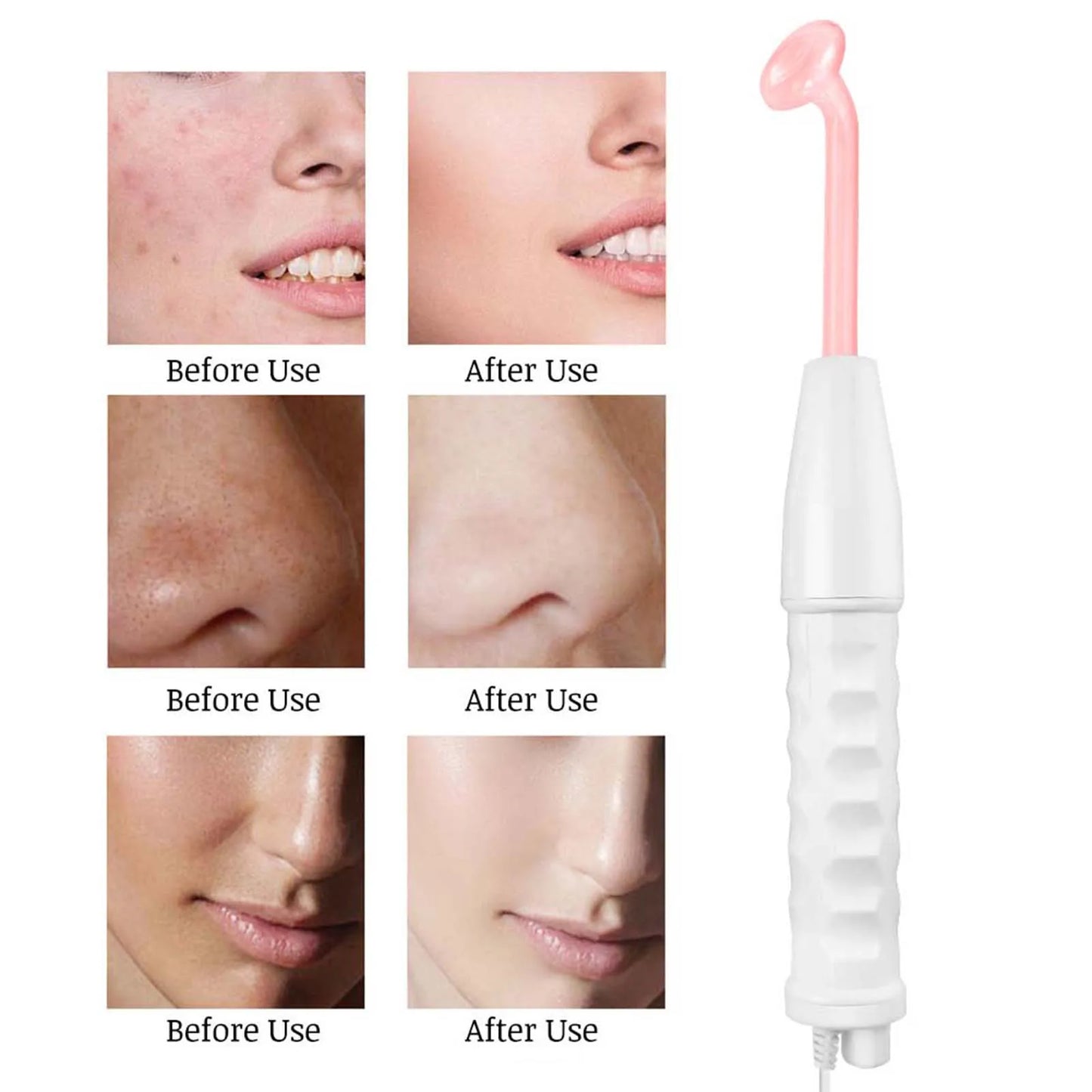High Frequency Facial Machine – Skin Tightening & Wrinkle Removal Device for Face & Body