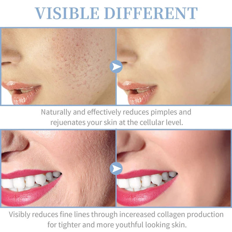 Portable High Frequency Skin Therapy Wand – Acne, Rejuvenation & Wrinkle Reduction Tool