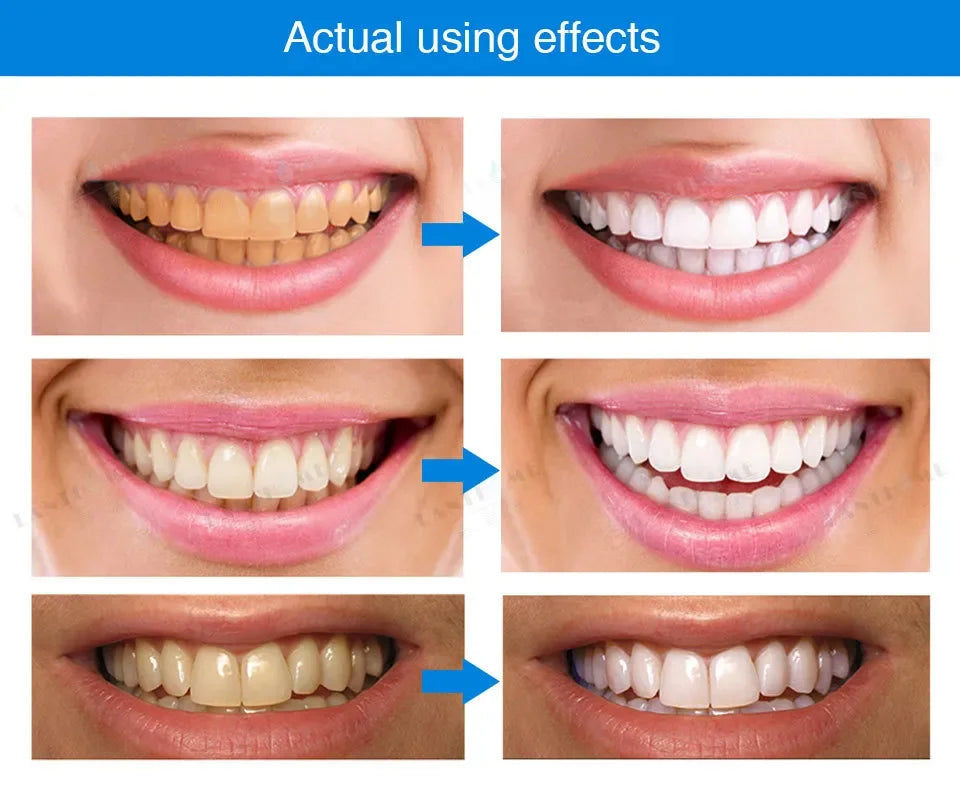 Purple Teeth Whitening Strips – Remove Stains, Fresh Breath & Brighten Smile