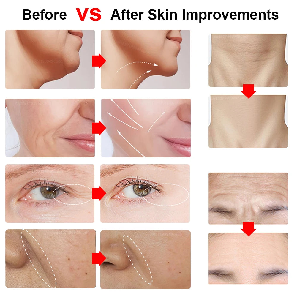 HIFU Face Lifting Machine – RF High Frequency EMS Anti-Aging Facial Massager