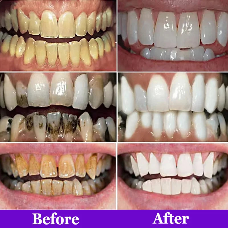 Purple Teeth Whitening Strips – Remove Stains, Fresh Breath & Brighten Smile